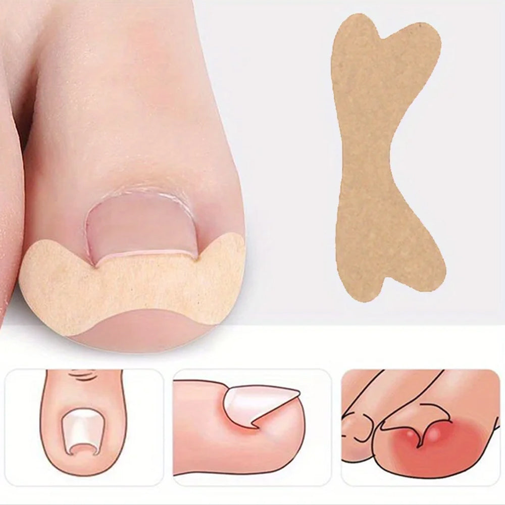60Pcs Ingrown Toenail Correction Stickers Adhesive Toenail Patches Foot Care