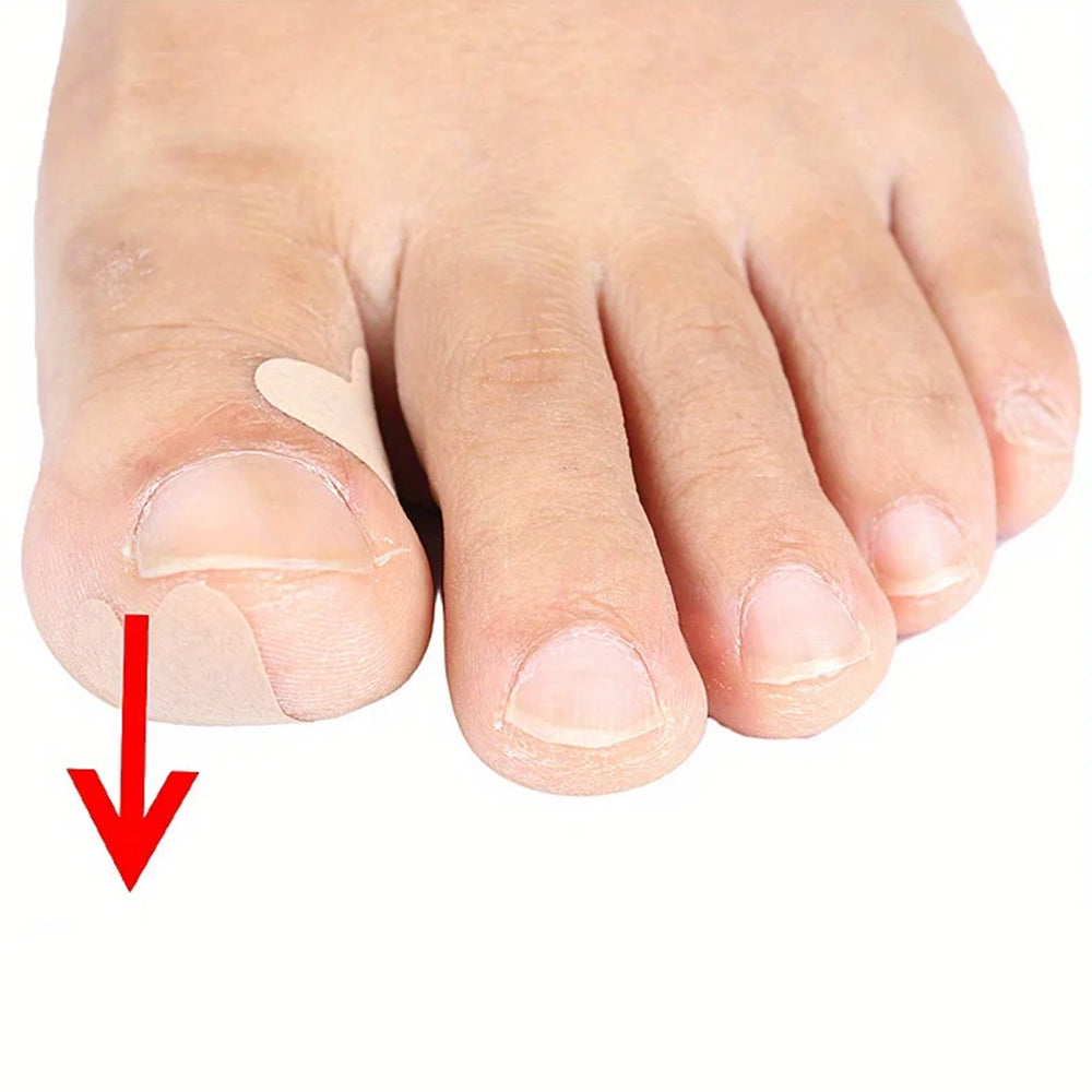 60Pcs Ingrown Toenail Correction Stickers Adhesive Toenail Patches Foot Care