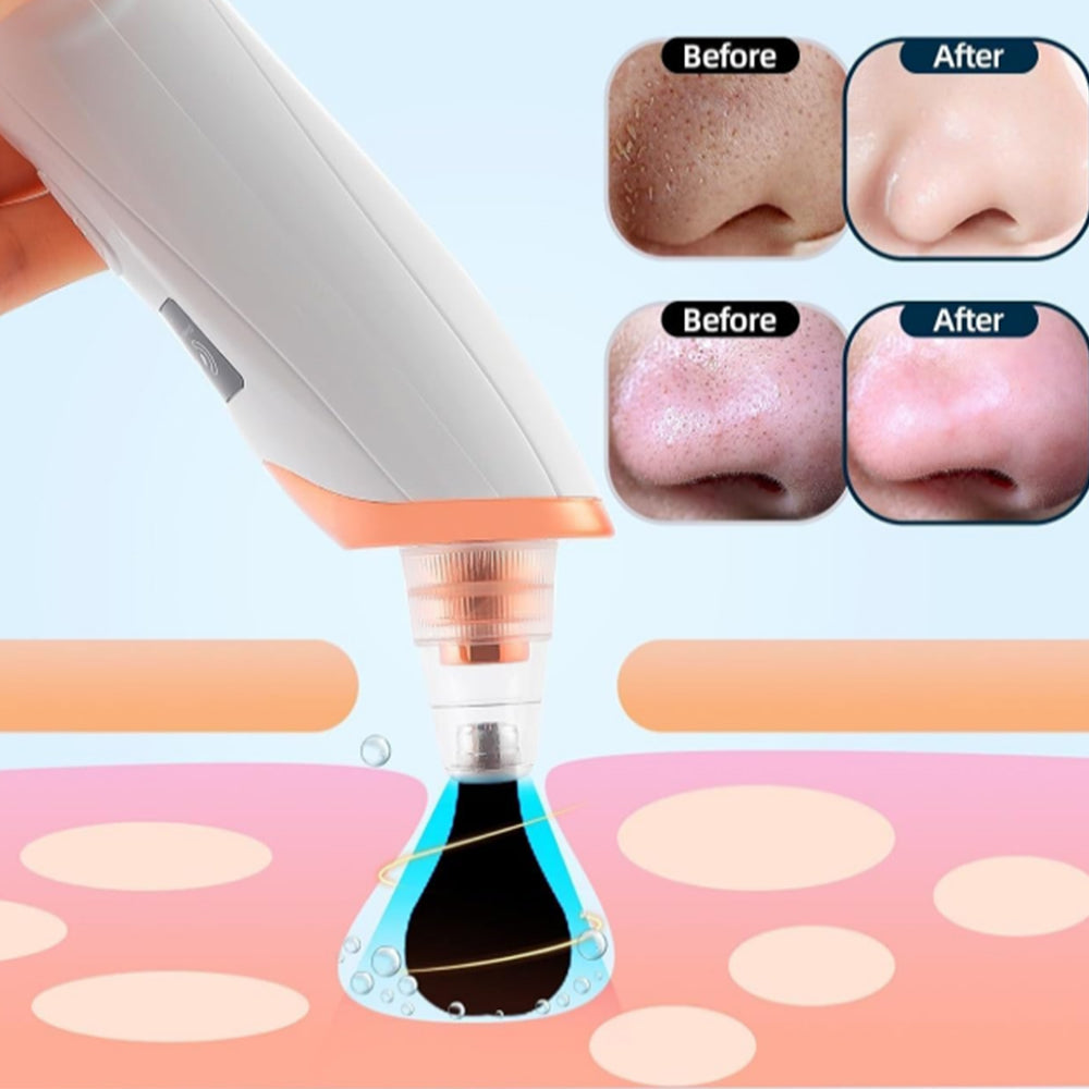 Vacuum Blackhead Remover Acne Pimple with 5 Suction Probes 4 Acne Needles Gold